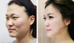 Không thể về nước vì phẫu thuật thẩm mỹ quá xinh