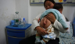 Bé trai 5 tháng tuổi mọc đuôi dài gần 13 cm