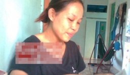 Tâm sự của người phụ nữ từng bị chồng thiêu sống