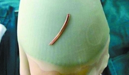 Hóc xương cá, bác sĩ chẩn đoán ung thư