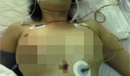 Bơm silicon lỏng khắp cơ thể, một phụ nữ tử vong