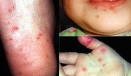 Dịch sởi chưa qua, chân tay miệng, thủy đậu đã thi nhau bùng phát