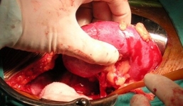 Chuyện rùng rợn ở đường dây bán nội tạng xuyên biên giới Việt