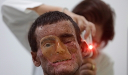 Bệnh gặp ánh nắng mặt trời là tan chảy