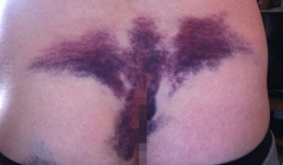 Chú rể phát hoảng với vết thâm tím hình thiên thần trên người mình