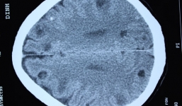 Hoảng hồn 50 ổ sán làm tổ trong não người