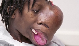 Cận cảnh khuôn mặt biến dạng vì khối u 'khổng lồ' 