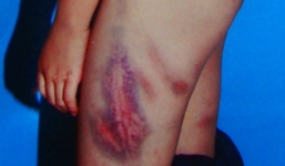 Mẹ kế hành hạ con chồng, dùng dao cạo rạch chồng nhiều nhát