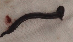 Choáng: Đỉa dài 20cm sống ký sinh trong mũi bệnh nhân 1 tháng