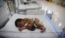 Bé gái sơ sinh có đầu mọc ra từ bụng