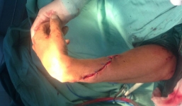  Đi đòi nợ, bị chém đứt lìa bàn tay