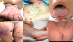 Bệnh chân tay miệng: Triệu chứng, điều trị và cách phòng ngừa