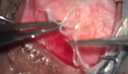 Hết hồn giun dài 19 cm sống trong mắt người