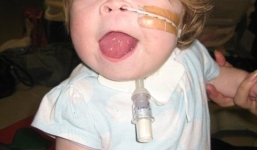 Xót thương hình ảnh bé gái lưỡi to bất thường