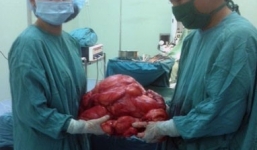 Phẫu thuật lấy khối u 11 kg trong bụng bệnh nhân