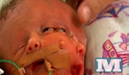 Bé sơ sinh có 2 mặt đã qua đời sau 19 ngày đến thế giới