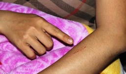 Kinh hoàng thiếu nữ bị rạch lưng dài hơn 10 cm