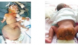 Phẫu thuật cắt bỏ thành công khối u quái nặng 2,6 kg