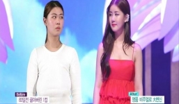 Cô gái có vòng một chảy sệ trở thành hot girl sau phẫu thuật thẩm mỹ