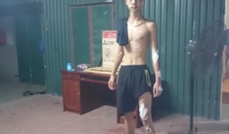 Xe tải 'hất' axit khiến hàng chục người bị bỏng