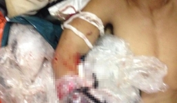 Cánh tay bị đứt lìa khi đang đánh cá trên biển