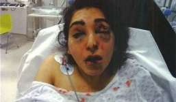 Nghi ngoại tình bố chồng đâm thủng mắt con dâu