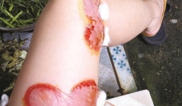 Bọ xít hút máu người tấn công: Tiền triệu phun thuốc, mua lo vào người