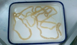 Kinh hoàng sán dây dài 2.5m ký sinh trong bụng người