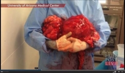 Phẫu thuật cắt bỏ khối u 20 kg trong bụng nữ bệnh nhân