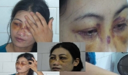 Chồng hành hạ vợ, bắt ăn phân lợn và đánh biến dạng khuôn mặt