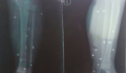 Bé 4 tuổi nhập viện vì đạn hoa cải găm chi chít ở hai chân