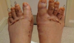 Shock: Cắt ngón chân để đi vừa giày cao gót