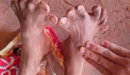 Kỳ bí gia tộc ba đời có con gái mang bàn chân 7 ngón