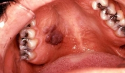 Hình ảnh rùng mình về các bệnh lây qua đường tình dục