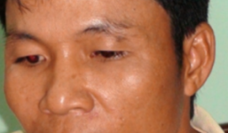 Ra đầu thú sau 10 năm chém trọng thương bạn nhậu