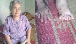 Cụ bà có 12 ngón chân, 11 ngón tay 3 tháng mới được ăn cơm thịt