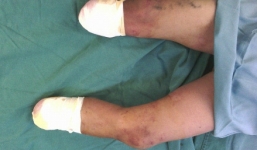 Ngủ quên trên đường ray, bé trai 11 tuổi bị tàu hỏa cán đứt 2 chân 