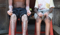 Hai cha con 'người rắn' ở Quảng Nam