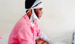 Bị tạt axit dã man trên đường đi làm về