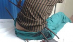 Sống sót hy hữu sau khi bị 3 thanh thép đâm xuyên qua người