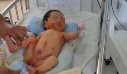 Bé gái sơ sinh bị bỏ rơi, dòi trắng và kiến bu khắp người bị thủng màng nhĩ hai bên