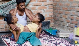 Chuyện tình cảm động của cặp song sinh dính liền yêu chung một người đàn ông