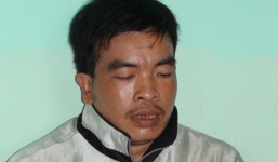 Đang ngủ trưa bị đồng nghiệp đánh chấn thương sọ não