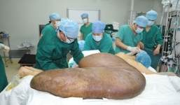 Cận cảnh ca phẫu thuật cắt bỏ khối u lớn nhất thế giới