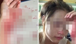 Nữ sinh Hải Phòng tự rạch tay ghê rợn vì nhớ người yêu