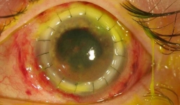 Bị vi khuẩn ăn nhãn cầu vì không vệ sinh kính áp tròng