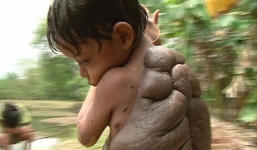 Cậu bé mang nốt ruồi khổng lồ ác tính như mai rùa 