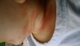 Sữa Physiolac đổ đến đâu, da bé mẩn đỏ đến đấy 