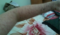 Nữ sinh Bình Dương tự rạch nát cánh tay chỉ vì buồn chán