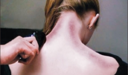 Những trường hợp tuyệt đối không được cạo gió vì có thể gây chết người